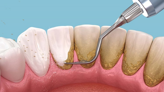 How to Remove Tartar from Teeth Without a Dentist